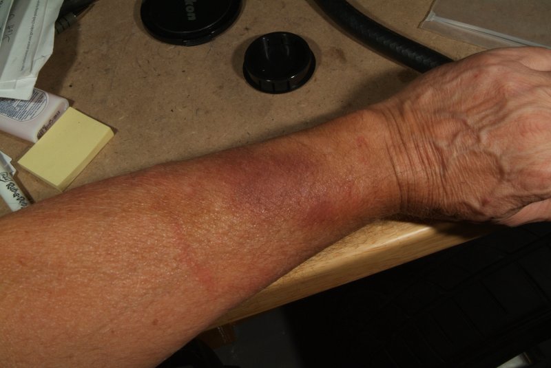 bad_arm_01.jpg